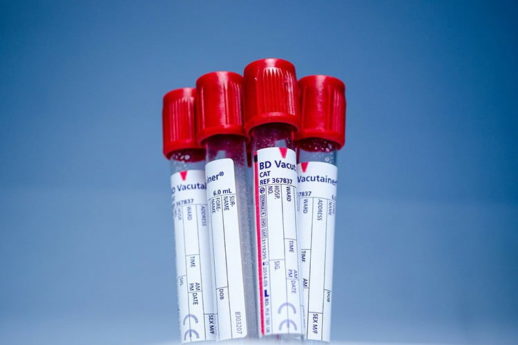 Tumori: entro cinque anni diagnosi da una sola goccia di sangue